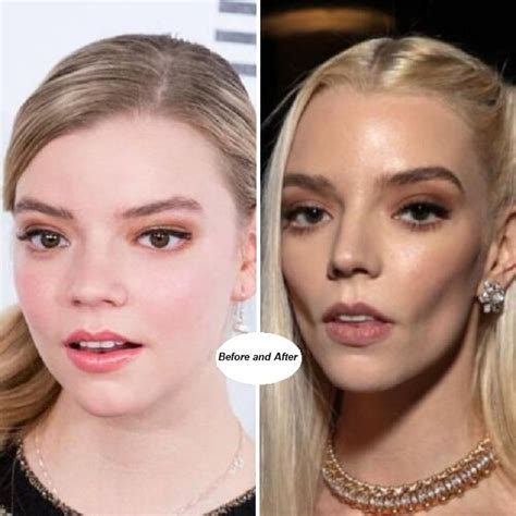 Anya Taylor Joy Before And After Plastic Surgery Anya Taylor Joy Before And After Plastic Surgery