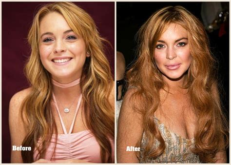 Celebrity Before And After Plastic Surgery Disasters Celebrity Before And After Plastic Surgery Disasters