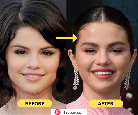 Did Selena Gomez Get Plastic Surgery Fabbon