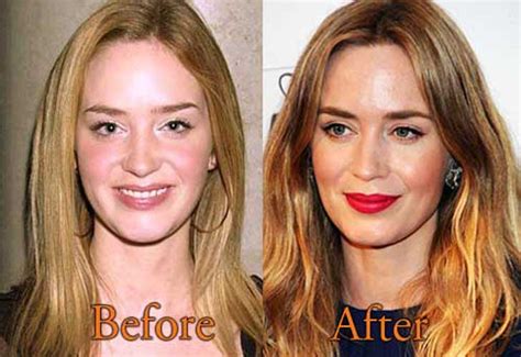Emily Blunt Plastic Surgery Rhinoplasty Nose Job Lip Augmentation Emily Blunt Plastic Surgery Rhinoplasty Nose Job Lip Augmentation
