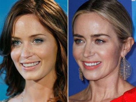 Emily Blunt Plastic Surgery