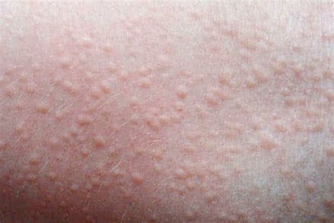 How To Heal Heat Rash Fast - 100% Guarantee - Sconnie Girl How To Heal Heat Rash Fast - 100% Guarantee - Sconnie Girl