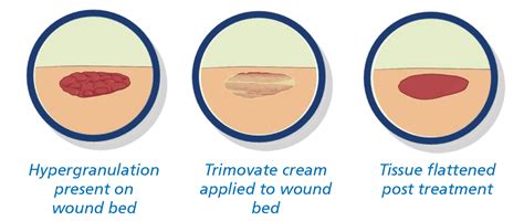 Hypergranulation