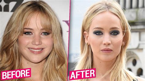 Jennifer Lawrence Plastic Surgery
