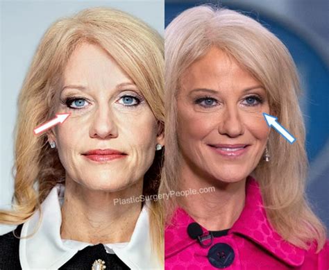 Kellyanne Conway Plastic Surgery