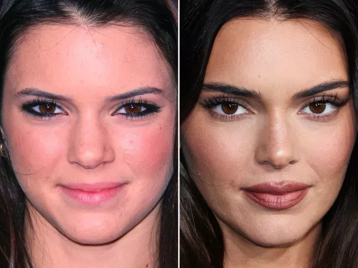 Kendall Jenner Before After Aesthetic Center Turkey Kendall Jenner Before After Aesthetic Center Turkey