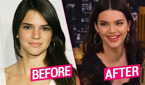 Kendall Jenner Plastic Surgery