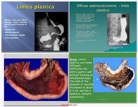 Linitis Plastica Of The Stomach Rojoson Medical Clinic Linitis Plastica Of The Stomach Rojoson Medical Clinic