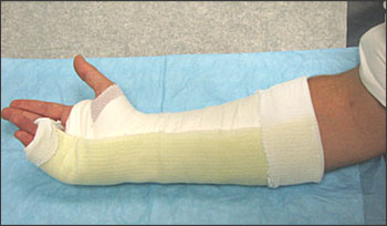 Pem Blog Fracture Fridays Can T Put A Finger On It Pem Blog Fracture Fridays Can T Put A Finger On It