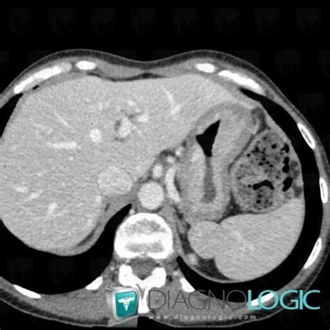 Radiology Case Gastric Linitis Plastica Ct Diagnologic Radiology Case Gastric Linitis Plastica Ct Diagnologic