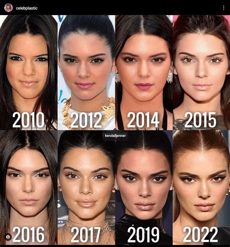 Rate Kendall Jenner Before And After Plastic Surgery R Vindictaratecelebs Rate Kendall Jenner Before And After Plastic Surgery R Vindictaratecelebs