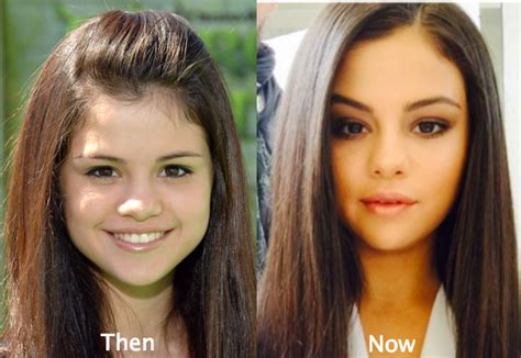 Selena Gomez Before And After The Plastic Surgery