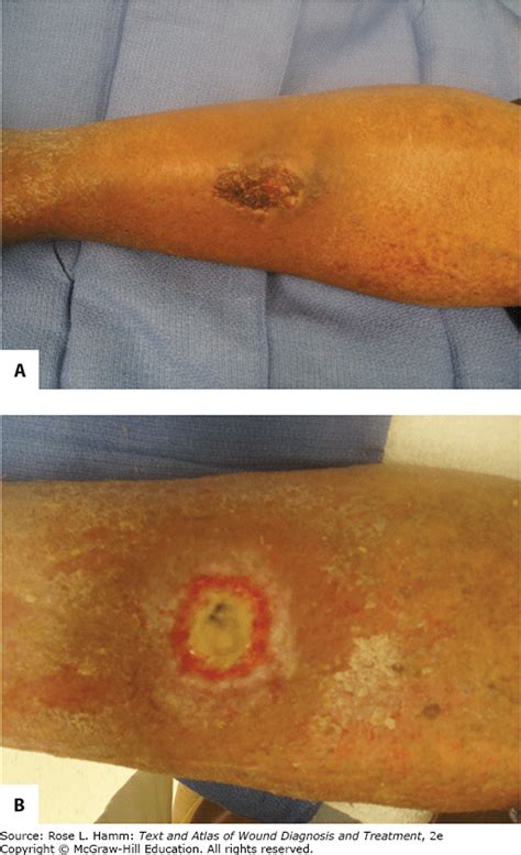 Slough Wound Pictures