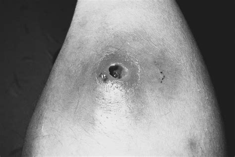 Snf Wound Care On Linkedin What Are Tunneling Wounds And What Form Of Snf Wound Care On Linkedin What Are Tunneling Wounds And What Form Of