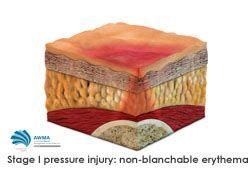 Stage 1 Pressure Injury Toolkit Agency For Clinical Innovation Stage 1 Pressure Injury Toolkit Agency For Clinical Innovation