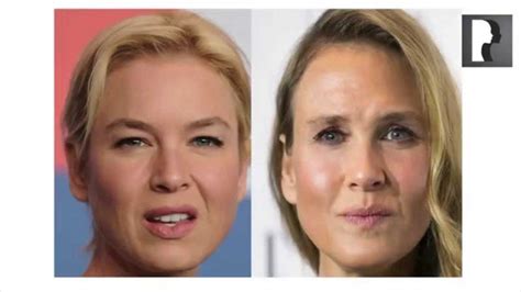 Top Cosmetic Surgeon Discusses Ren E Zellweger Plastic Surgery Rumors Top Cosmetic Surgeon Discusses Ren E Zellweger Plastic Surgery Rumors